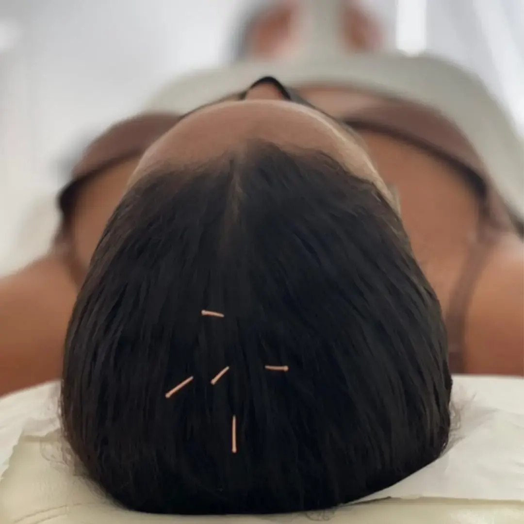 Aiguilles d’acupuncture posées sur le cuir chevelu d’une personne allongée lors d’une séance de médecine traditionnelle.